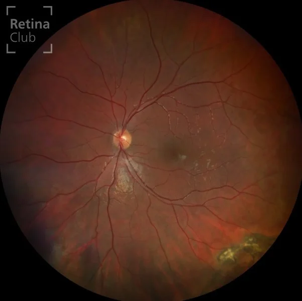 Te presentamos un nuevo caso clínico destacado en @retina.club del ATLAS de RETINA dónde podrás consultar los signos y detalles de Retinosquisis juvenil ligada al cromosoma X.

¡Síguenos y descubrirás cada semana una nueva publicación con los casos clínicos más completos!

No olvides que puedes participar y sube tu caso clínico en www.retinaclub.es Participa del proyecto y juntos podremos apoyar la formación y divulgación en la especialidad de retina.

Autor: @Julio José González

#oftalmologia #retina #atlasretina #retinaclub #clarusclub