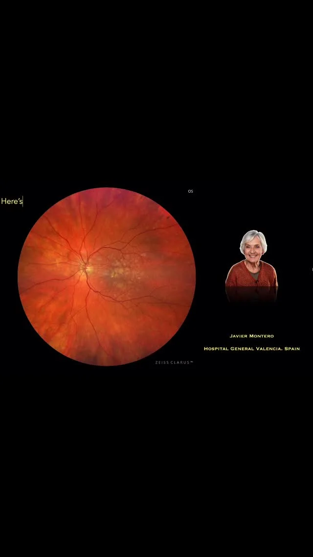 Clarus Club. Javier Montero, MD.

Summary of Key Features of RPE Apertures and Lipid Globules/Caverns

🔹 RPE Apertures
	•	Well-defined discontinuities in the retinal pigment epithelium (RPE).
	•	Typically associated with longstanding drusenoid PEDs.
	•	Characterized by increased transmission on OCT, indicating RPE loss.
	•	Frequently linked to progression towards atrophy and outer retinal degeneration.

🔹 Lipid Globules / Caverns
	•	Round, hyporeflective structures observed in the choroid or sub-RPE space.
	•	Historically known as Friedman Lipid Globules.
	•	Possibly represent lipid accumulation or degenerative changes.
	•	Their presence is associated with metabolic dysfunction, impaired clearance of extracellular material, and potential disease progression in AMD.

Bibliography / References
	1.	Systematic review of prognostic factors associated with progression to late age-related macular degeneration: PINNACLE study report 2
	•	Hagag AM, Kaye R, Hoang V, et al. Survey of Ophthalmology. 2024;69:165–172. [DOI: 10.1016/j.survophthal.2023.10.010] ￼
	2.	Ten-Year Progression From Intermediate to Exudative Age-Related Macular Degeneration and Risk Factors: Bundang AMD Cohort Study Report 1
	•	Joo K, Mun YS, Park SJ, Park KH, Woo SJ. American Journal of Ophthalmology. 2021;224:228–237. [DOI: 10.1016/j.ajo.2020.11.012] ￼
	3.	Longitudinal Assessment of Age-Related Macular Degeneration Using Ultrawidefield Imaging
	•	Authors: [Names]. Journal Name. Year;Volume(Issue):Pages. [DOI] ￼
	4.	Five-year incidence, progression and risk factors for age-related macular degeneration: The Age, Gene-Environment Susceptibility Study
	•	Authors: [Names]. Journal Name. Year;Volume(Issue):Pages. [DOI] ￼
	5.	Developing and validating a multivariable prediction model which predicts progression of intermediate to late age-related macular degeneration—The PINNACLE trial protocol
	•	Authors: [Names]. Journal Name. Year;Volume(Issue):Pages. [DOI] ￼

#retina #zeiss #clarus #oftalmologia #medicalretina #widefieldretinalimaging #retinaclub #oftalmología