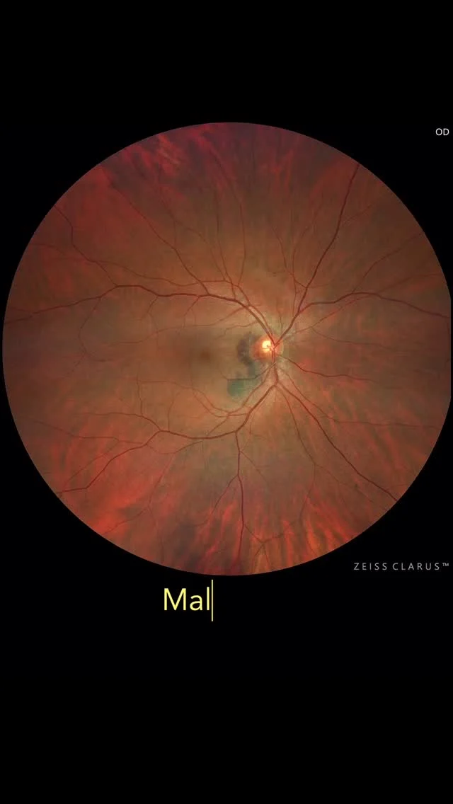Clarus Club. Clinical Case
A 40-year-old male presented with complaints of a scotoma and progressive loss of vision in his right eye. His past medical history was unremarkable except for arterial hypertension. Ophthalmologic examination revealed a peripapillary hemorrhage associated with a juxtpapillary neovascular membrane.

Multimodal imaging, including optical coherence tomography (OCT) and indocyanine green angiography (ICGA), demonstrated a neovascular lesion characterized by aneurysmal dilations, suggesting the diagnosis of polypoidal choroidal vasculopathy (PCV), possibly associated with pachychoroid features.

The patient was treated with intravitreal anti-VEGF injections, achieving a favorable anatomical and functional outcome.

Discussion
This case highlights the importance of considering pachychoroid-related neovascular disorders, such as polypoidal choroidal vasculopathy, even in relatively young patients. It is crucial to differentiate these entities from typical age-related macular degeneration (AMD), which usually presents in older individuals and is associated with additional signs of ocular aging. In a 40-year-old patient, the diagnosis of AMD should be questioned unless supported by strong clinical evidence.

Learning Points
	•	Polypoidal choroidal vasculopathy may mimic AMD but can occur in younger patients, often in association with pachychoroid phenotypes.
	•	Multimodal imaging is essential for the correct diagnosis.
	•	In younger patients presenting with exudative macular lesions, alternative diagnoses beyond AMD must be considered.

#retina #zeiss #clarus #oftalmologia #medicalretina #widefieldretinalimaging