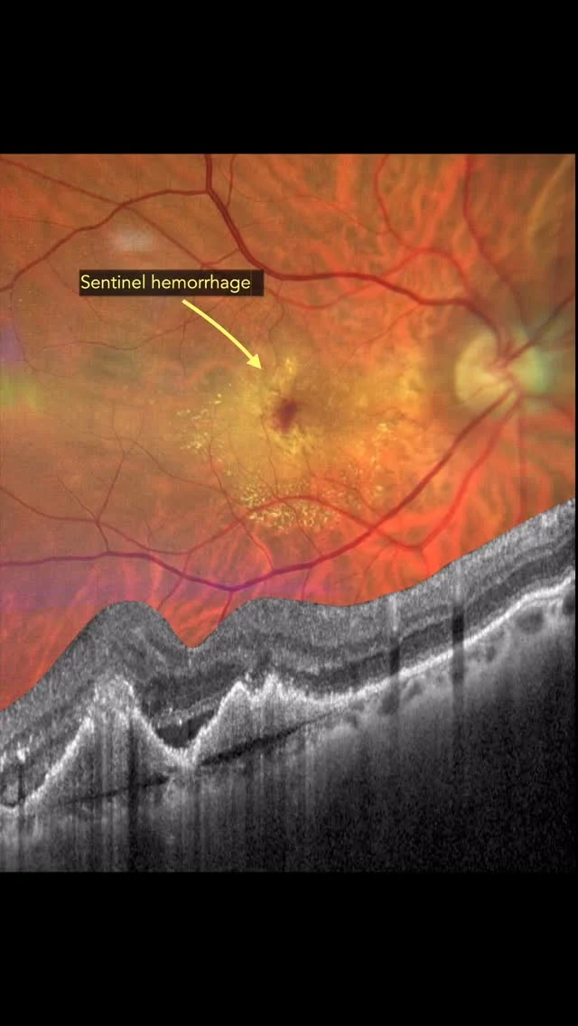 ClarusClub

In this case, we observed a large vascularized pigment epithelial detachment with a small intraretinal hemorrhage and lipid exudation. Multimodal imaging revealed that this case actually presented two neovascular tufts alongside two retino-retinal anastomoses, confirming the diagnosis of what is most likely a case of multiple type 3 neovascular lesions—commonly referred to as multi-RAPs.

Additionally, we noted other peculiar signs such as the choroidal cleft, a feature associated with both type 1 and type 3 lesions. This finding suggests a more torpid  behavior and is linked to an increased risk of retinal pigment epithelium (RPE) tear.

Lastly, a curious detail: a dilated, tortuous choroidal vein within the optic nerve sheath, which in some textbooks is referred to as the choriovaginal vessel.

We hope you found this case interesting and helpful.
Warm greetings from Clarus Club and Retina Club.
Javier Montero

Special thanks to Dr. Sergio Copete for sharing this excellent case for multimodal study.

#retina #zeiss #clarus #oftalmologia #medicalretina #widefieldretinalimaging #retinaclub #oftalmología #atlas