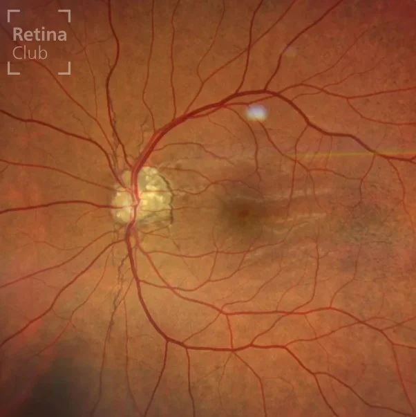 👁️‍🗨️ Nuevo caso clínico en el ATLAS de RETINA 👁️‍🗨️

Te presentamos un nuevo caso clínico destacado en el ATLAS de RETINA, donde podrás consultar los signos y detalles de las Drusas de Papila y Estrías Angioides.

Las drusas de papila son formaciones hialinas de entre 5 y 1.000 micras situadas por delante de la lámina cribosa. Pueden ser visibles u ocultas y suelen provocar alteraciones campimétricas secundarias a la compresión axonal, aunque generalmente preservan la agudeza visual.

Es fundamental realizar un diagnóstico diferencial con el papiledema. Además, pueden coexistir con estrías angioides, especialmente en patologías como el pseudoxantoma elástico.

📚 Consulta el caso completo en 👉 www.retinaclub.es

#RetinaClub #CasosClínicos #Oftalmología #DrusasDePapila #EstríasAngioides #ATLASRetina #Neurooftalmología #FormaciónMédica