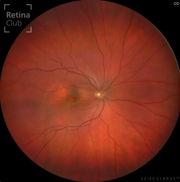 🔍 Nuevo caso clínico en el ATLAS de RETINA 🔍

Te presentamos un nuevo caso clínico destacado en el ATLAS de RETINA, donde podrás consultar los signos y detalles de la Neovascularización Paquicoroidea (PNV).

Una entidad patológica caracterizada por el desarrollo de neovasos bajo el epitelio pigmentado de la retina (EPR), en pacientes con signos clínicos de enfermedad paquicoroidea. Esta condición forma parte del espectro de enfermedades paquicoroideas y suele asociarse con la corioretinopatía central serosa y la vasculopatía coroidea polipoidea.

📚 Consulta el caso completo en 👉 www.retinaclub.es

#RetinaClub #CasosClínicos #Oftalmología #NeovascularizaciónPaquicoroidea #PNV #ATLASRetina #EducaciónMédica