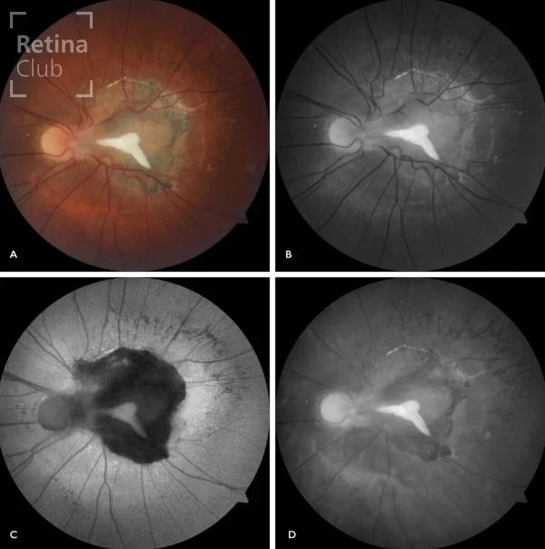 Te presentamos un nuevo caso clínico destacado del ATLAS de RETINA dónde podrás consultar los signos y detalles  de un Hamartoma combinado de retina y epitelio pigmentario retiniano. 
 Autor: @gilipablo 

¡Síguenos y descubrirás cada semana una nueva publicación con los casos clínicos más completos! No olvides que puedes participar y sube tu caso clínico en www.retinaclub.es Participa del proyecto y juntos podremos apoyar la formación y divulgación en la especialidad de retina.

#oftalmologia #retina #atlasretina #retinaclub #clarusclub