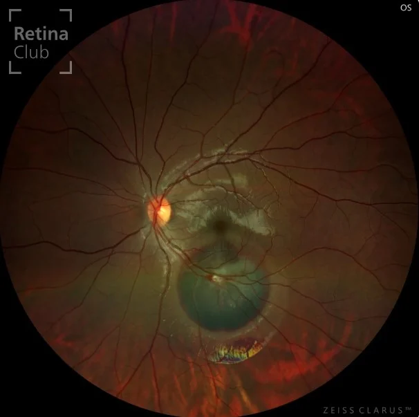 Te presentamos un nuevo caso clínico destacado del ATLAS de RETINA dónde podrás consultar los signos y detalles de la distrofia de conos. ¡Síguenos y descubrirás cada semana una nueva publicación con los casos clínicos más completos!

No olvides que puedes participar y sube tu caso clínico en www.retinaclub.es Participa del proyecto y juntos podremos apoyar la formación y divulgación en la especialidad de retina.

Autor: @gilipablo 

#oftalmologia #retina #atlasretina #retinaclub #clarusclub
¡Síguenos y descubrirás cada semana una nueva publicación con los casos clínicos más completos!