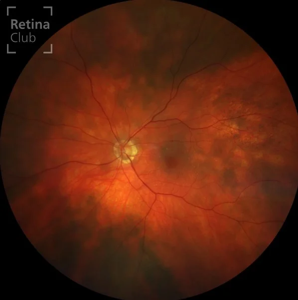 Te presentamos un nuevo caso clínico destacado en @retina.club del ATLAS de RETINA dónde podrás consultar los signos y detalles de Retinosquisis juvenil ligada al cromosoma X.

¡Síguenos y descubrirás cada semana una nueva publicación con los casos clínicos más completos!