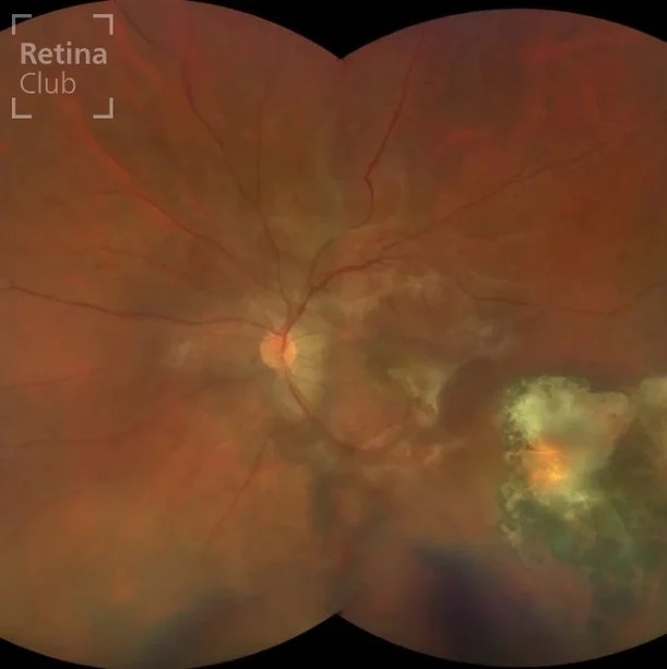 Te presentamos un nuevo caso clínico destacado del ATLAS de RETINA dónde podrás consultar los signos y detalles de una Membrana epiretiniana macular en paciente con toxoplasmosis. ¡Síguenos y descubrirás cada semana una nueva publicación con los casos clínicos más completos!

No olvides que puedes participar y sube tu caso clínico en www.retinaclub.es Participa del proyecto y juntos podremos apoyar la formación y divulgación en la especialidad de retina.

Autor: @drabarbaradelas 

#oftalmologia #retina #atlasretina #retinaclub #clarusclub