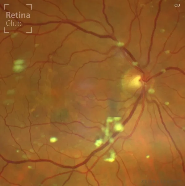 🦋 Nuevo caso clínico en el ATLAS de RETINA 🦋

Te presentamos un nuevo caso clínico destacado en el ATLAS de RETINA, donde podrás consultar los signos y detalles de las Distrofias Maculares en Patrón.

Se trata de un grupo de enfermedades maculares autosómicas dominantes, caracterizadas por distintos patrones de depósito de pigmento en la mácula. Dentro de este grupo se encuentra la conocida Distrofia Macular en Alas de Mariposa, con su particular aspecto en las pruebas de imagen.

📚 Consulta el caso completo en 👉 www.retinaclub.es

#RetinaClub #CasosClínicos #Oftalmología #DistrofiasMaculares #AlasDeMariposa #ATLASRetina #FormaciónMédica