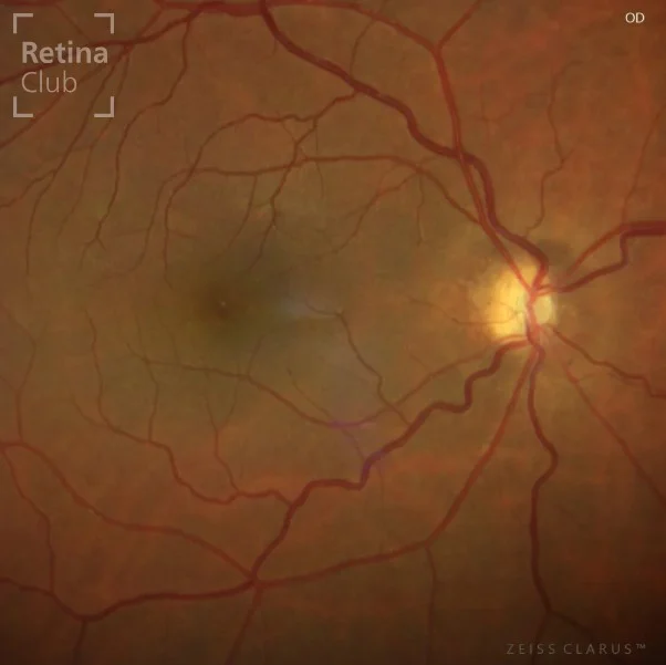 👁️‍🗨️ Nuevo caso clínico en el ATLAS de RETINA 👁️‍🗨️

Te presentamos un nuevo caso clínico destacado en el ATLAS de RETINA, donde podrás consultar los signos y detalles de la Hipoplasia del Nervio Óptico.

Una patología caracterizada por una papila de reducido tamaño y disminución del número de axones. Puede presentarse de forma uni o bilateral y, en un alto porcentaje de casos (90%), se asocia a anomalías del sistema nervioso central y alteraciones del desarrollo.

📚 Consulta el caso completo en 👉 www.retinaclub.es

#RetinaClub #CasosClínicos #Oftalmología #HipoplasiaNervioÓptico #ATLASRetina #Neurooftalmología #FormaciónMédica