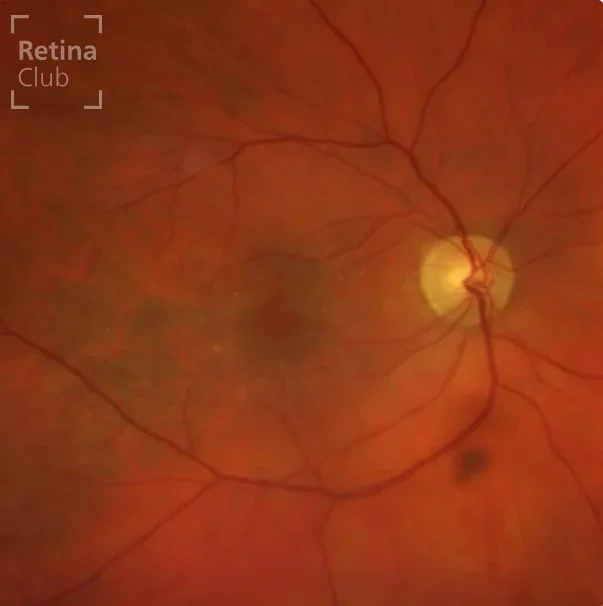 🔎 Nuevo caso clínico en el ATLAS de RETINA 🔎

Te presentamos un nuevo caso clínico destacado en el ATLAS de RETINA, donde podrás consultar los signos y detalles del Agujero Macular Laminar.

Un trastorno vitreorretiniano que se caracteriza por un contorno foveal irregular y una ruptura en las capas internas de la fóvea. Esta condición incluye la separación entre la retina interna y externa, pero sin afectar el espesor total de la fóvea, manteniéndose intactos los fotorreceptores.
La aparición bilateral de este hallazgo es poco frecuente, con una prevalencia estimada en la literatura entre el 5% y el 30%.

📚 Consulta el caso completo en 👉 www.retinaclub.es

#RetinaClub #CasosClínicos #Oftalmología #AgujeroMacularLaminar #ATLASRetina #FormaciónMédica #OCT